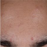 Neutrogena acne-after-2