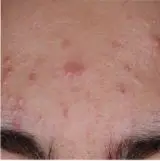 Neutrogena acne-before-2